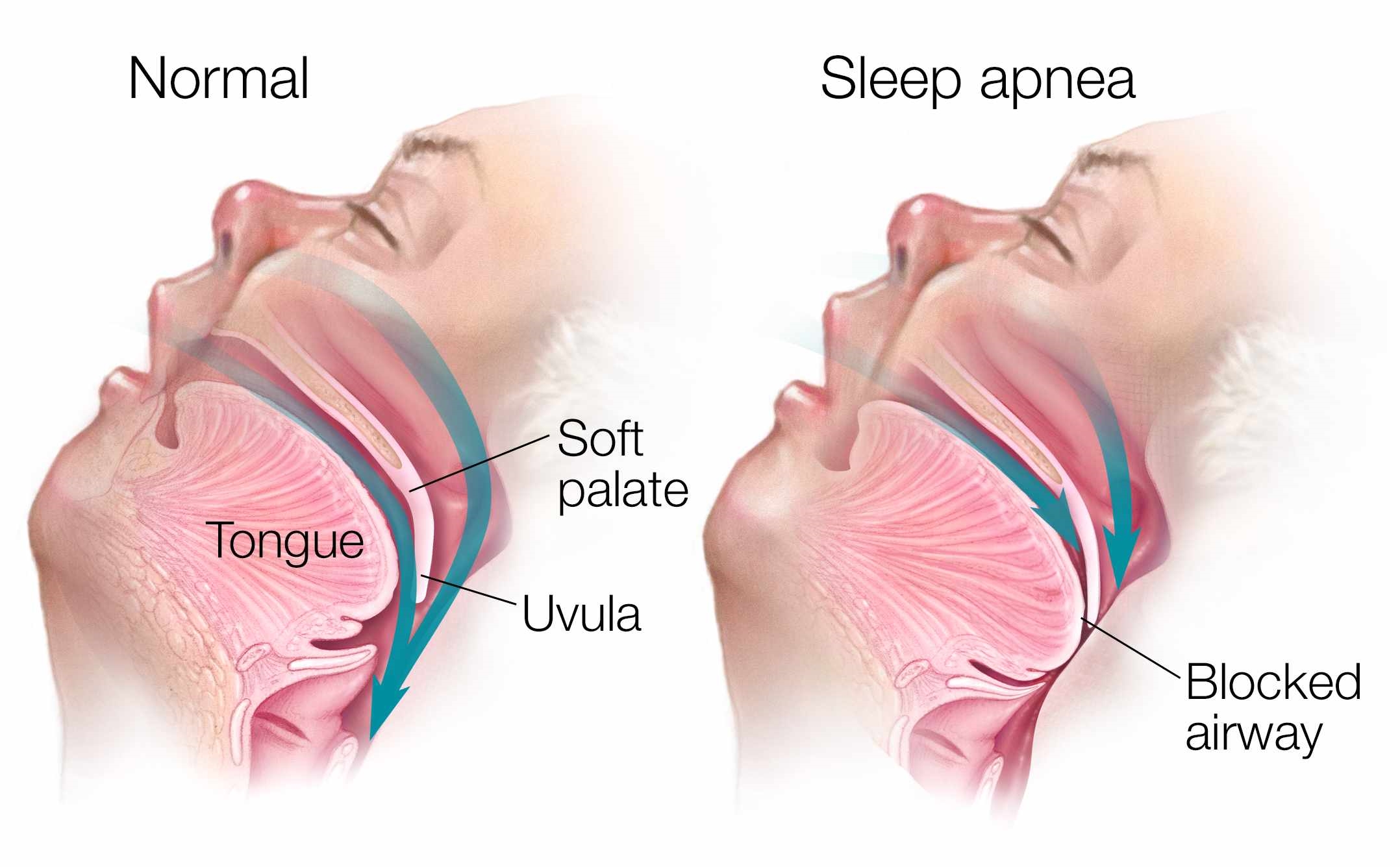 Does Sleep Apnea Cause Sleeplessness